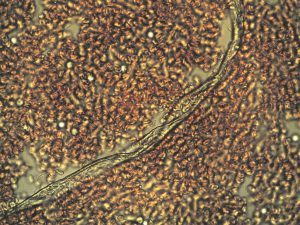 Shedding - the evidence - tubular structure and clumping cells in an unvaccinated patient