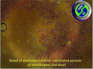 Blood of an unvaccinated little boy suffering partial paralysis and vertigo; parents had had second Covid dose four months earlier