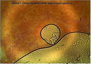 Blood of an unvaccinated child with vaccinated parents shows graphene oxide and damaged cells 