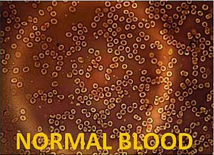 normal blood cells